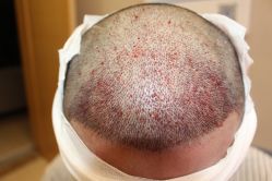 -大麦微针植发丨全国连锁