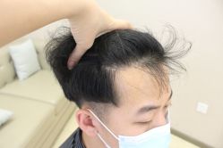 -大麦微针植发丨全国连锁