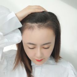 -碧莲盛·不剃发植发