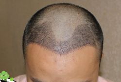 -大麦微针植发丨全国连锁