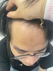 -大麦微针植发全国连锁