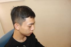 点击看大图 -大麦微针植发丨全国连锁