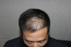 -大麦微针植发丨全国连锁