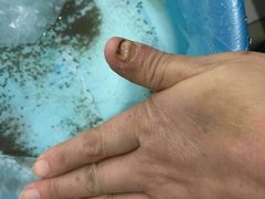 -世龙世家灰指甲·甲沟炎·跖疣护理·修脚(东江湾路店)