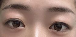 体验前-素美医疗美容·西南眼鼻整形·修复基地