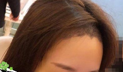 -大麦微针植发丨全国连锁