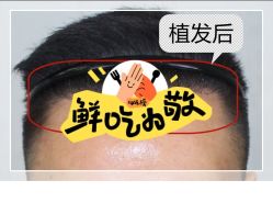 -大麦微针植发全国连锁