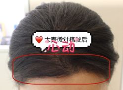 -大麦微针植发全国连锁