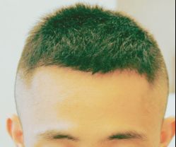 -大麦微针植发丨全国连锁