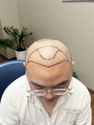 体验前-大麦微针植发全国连锁