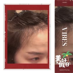 -大麦微针植发全国连锁