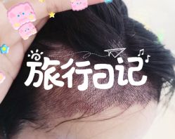 -大麦微针植发全国连锁