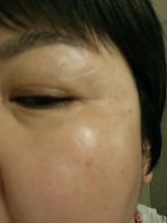 点击看大图 祛斑做完第十天-北京英煌医疗美容