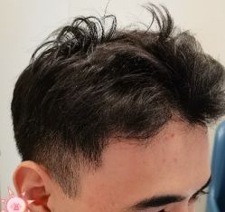 -大麦微针植发丨全国连锁