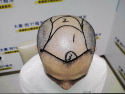 -大麦微针植发丨全国连锁