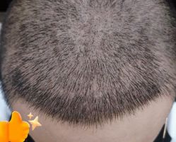 -大麦微针植发丨全国连锁