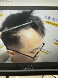 -大麦微针植发丨全国连锁