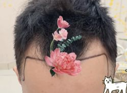 -大麦微针植发全国连锁