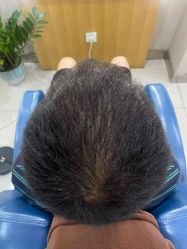 -大麦微针植发全国连锁