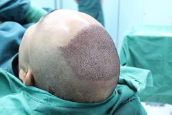 点击看大图 -大麦微针植发丨全国连锁