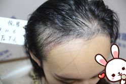 点击看大图 -大麦微针植发丨全国连锁