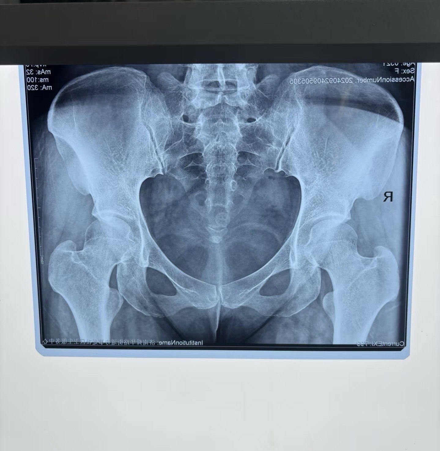 骨盆修复,x光