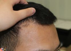 -大麦微针植发丨全国连锁