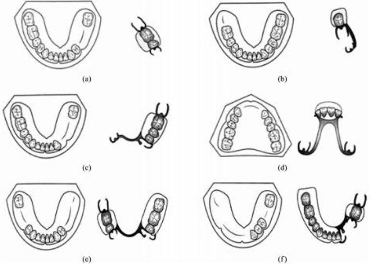 尔睦科普|牙列缺损有哪些分类?