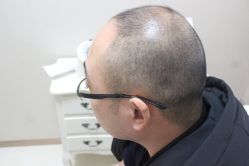 点击看大图 -大麦微针植发丨全国连锁