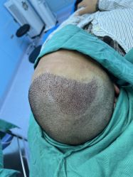 -大麦微针植发全国连锁