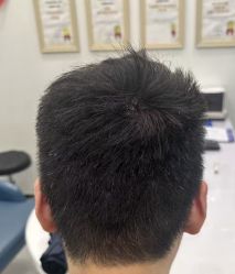 -大麦微针植发全国连锁