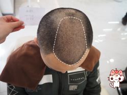 -大麦微针植发丨全国连锁