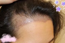 -大麦微针植发丨全国连锁