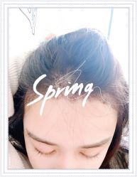 点击看大图 体验后-大麦微针植发全国连锁