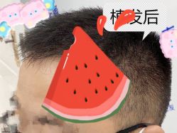 -大麦微针植发全国连锁