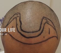 -大麦微针植发全国连锁