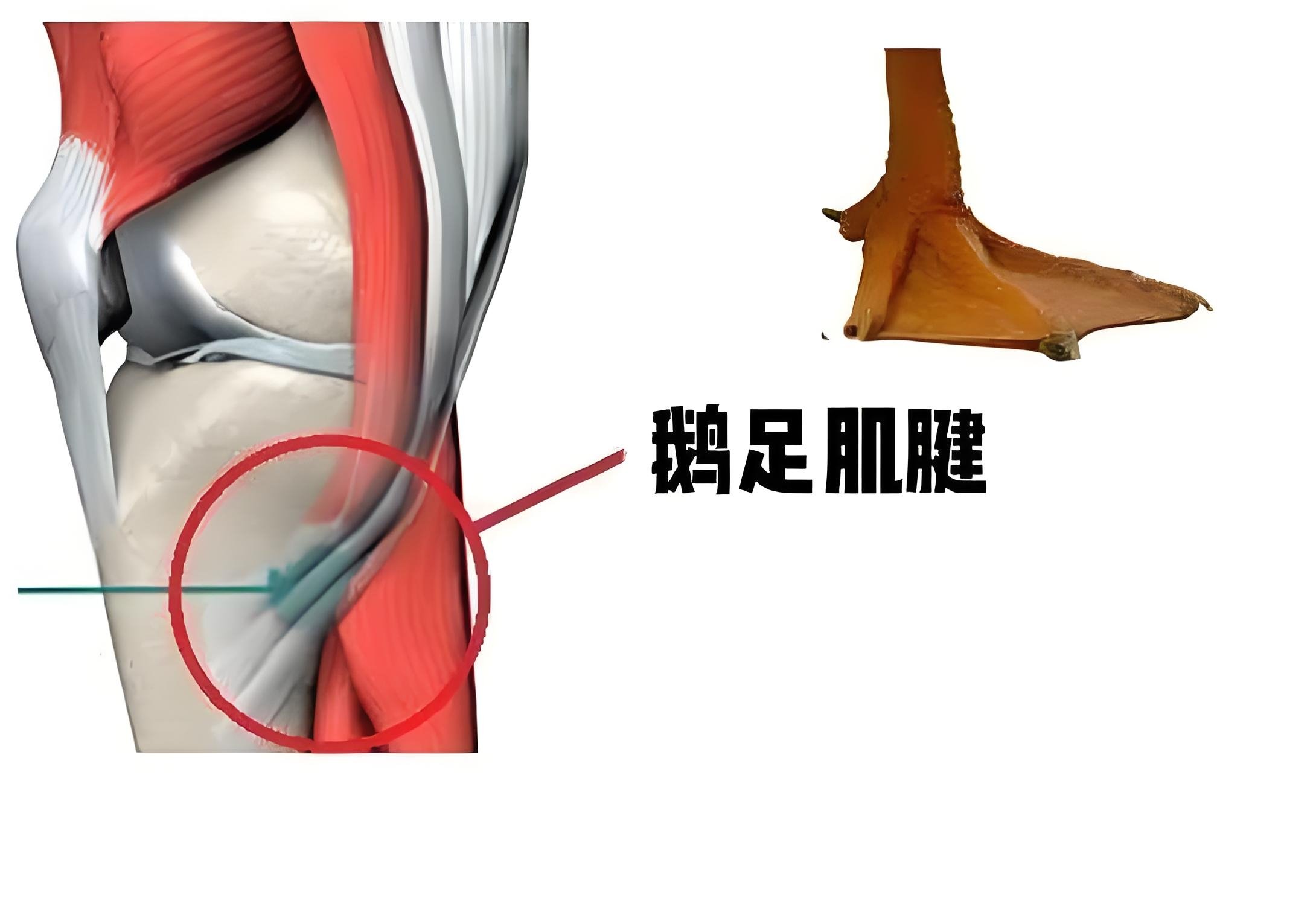 膝关节鹅掌腱位置图片图片