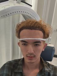 -大麦微针植发丨全国连锁