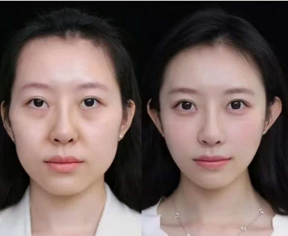 自体脂肪填充后我终于摆脱了苦相脸