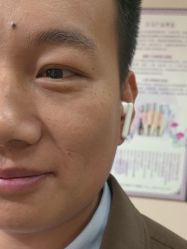 -北京美痣堂古方祛痣斑疣瘊