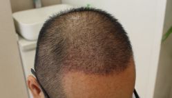 -大麦微针植发丨全国连锁