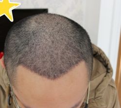 -大麦微针植发丨全国连锁