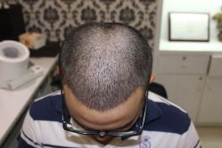 -大麦微针植发全国连锁