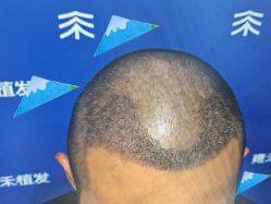 -雍禾植发全国连锁