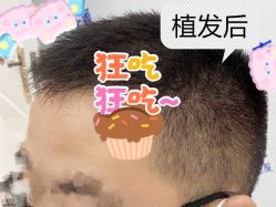 -大麦微针植发全国连锁