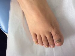 -德哥灰指甲脚气甲沟炎跖疣护理