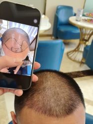 -碧莲盛·不剃发植发