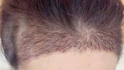 -大麦微针植发丨全国连锁