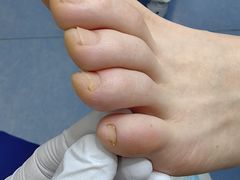 -Andrew指甲专科灰指甲·甲沟炎矫正·3D步态矫形鞋垫定制(上海法华镇路旗舰店)