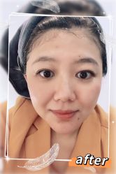 体验后-More摩尔医美の注射线雕光电中心